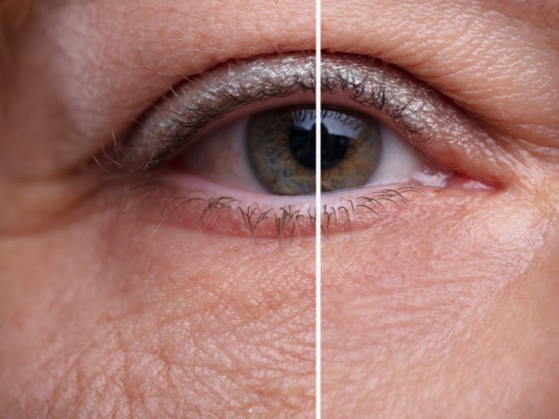 雷射眼睛手術能改善什麼