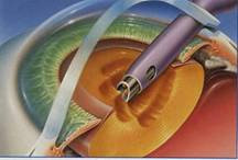 白內障超音波晶體乳化術(Phacoemulsification)