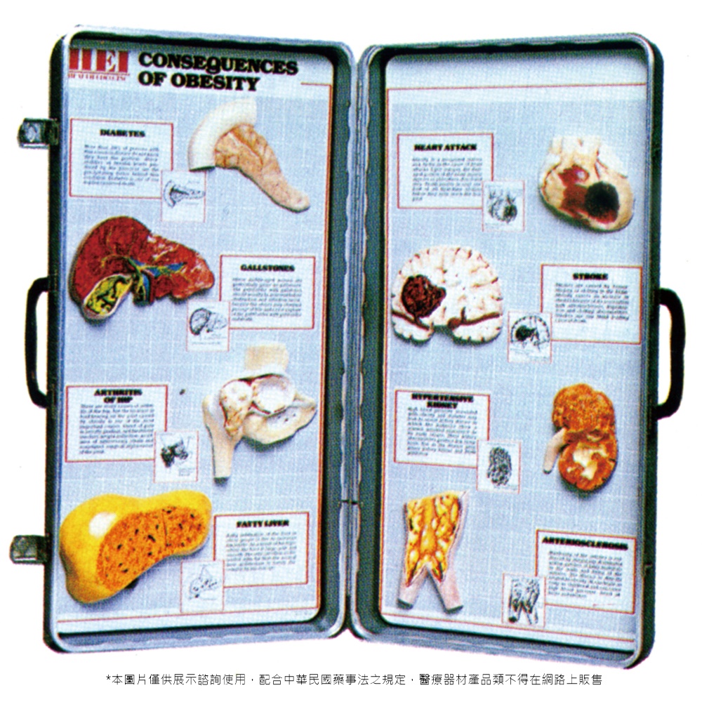 肥胖的後果展示模型