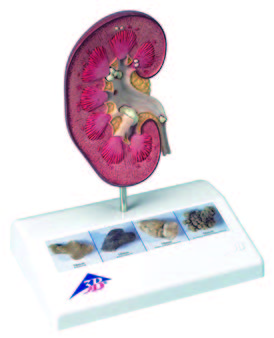 腎結石模型(3B)