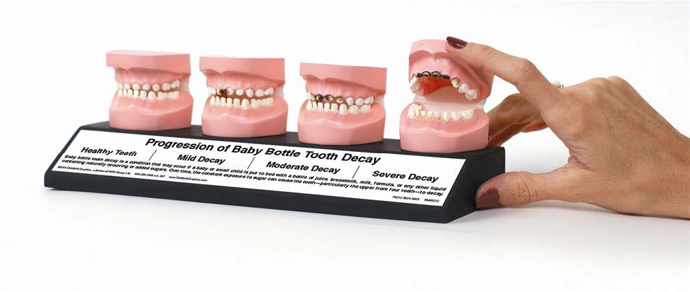 幼童蛀牙模型(