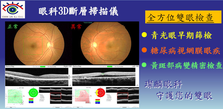 iVue眼科3D斷層掃描儀2