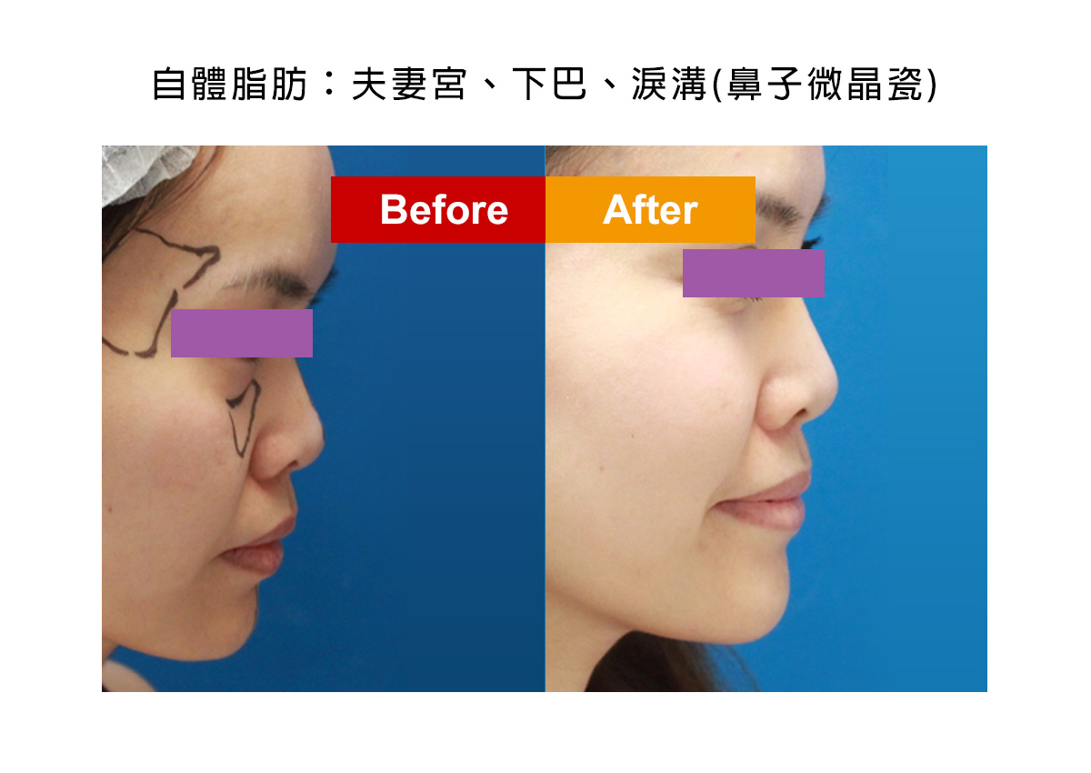 自體補脂案例