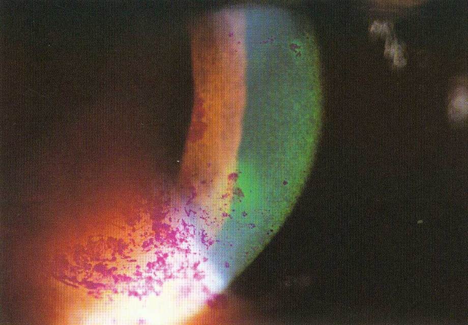 乾眼症(表淺性點狀角膜炎)