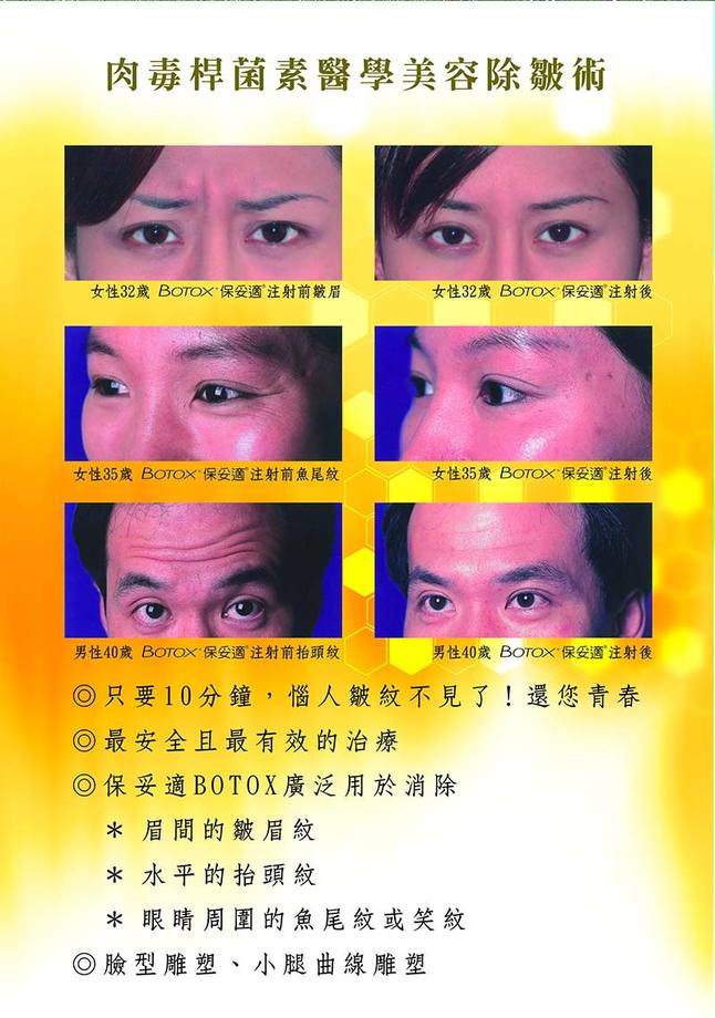 肉毒桿菌數醫學美容除皺術