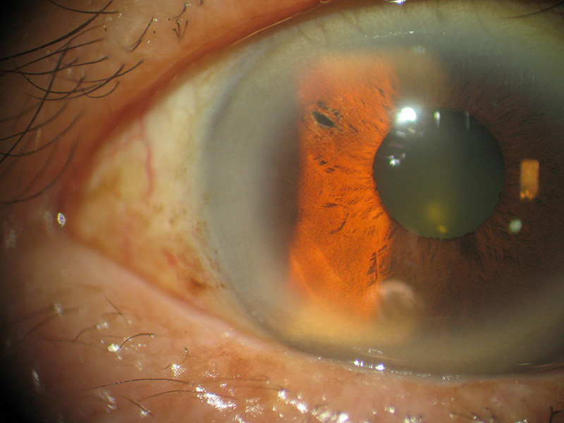 青光眼〈雷射虹膜造孔〉