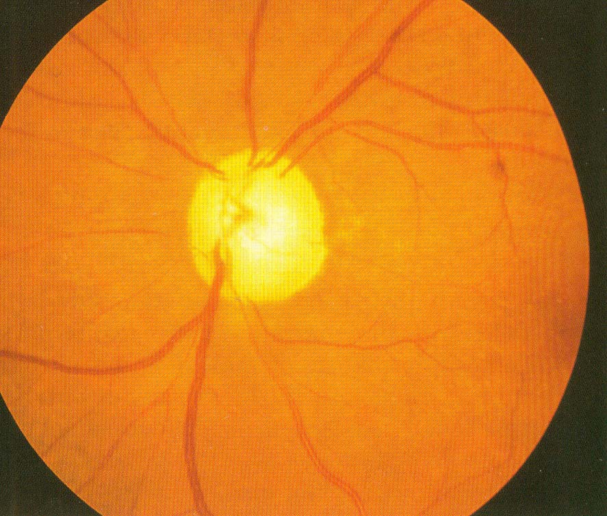 視神經萎縮(青光眼)