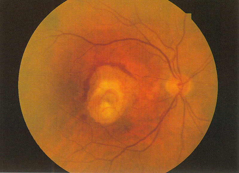老年性濕性黃斑部病變