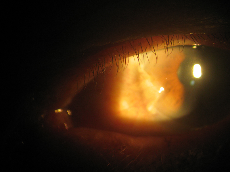 眼翼(翼狀赘肉)