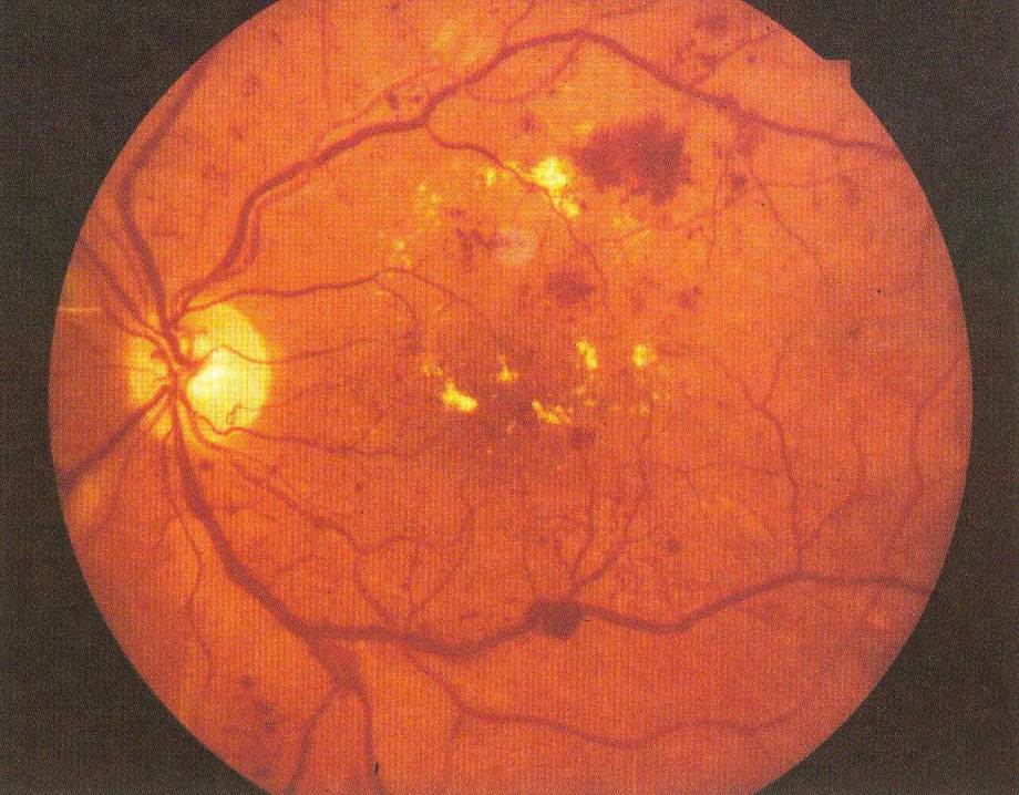 糖尿病視網膜病變
