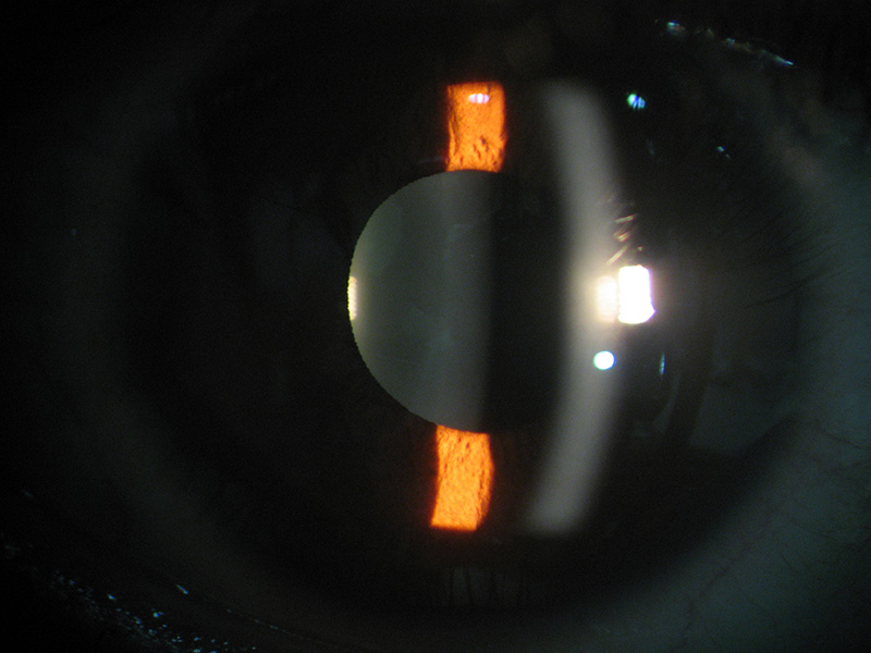 正常裂隙灯下的眼睛